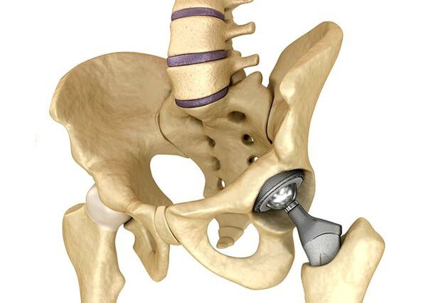 Endoprosthetic of the hip joint