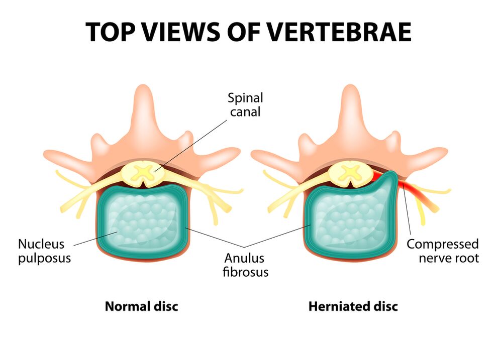 Healthy Intervertebral and hernia