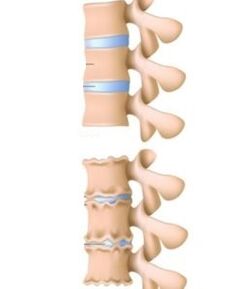 Causes of osteoporosis