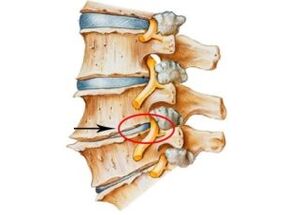 Signs and symptoms of osteoarthritis