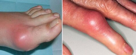 joint appearance with arthritis