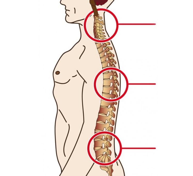 Determine the location of cervical, thoracic and lumbar bone degeneration
