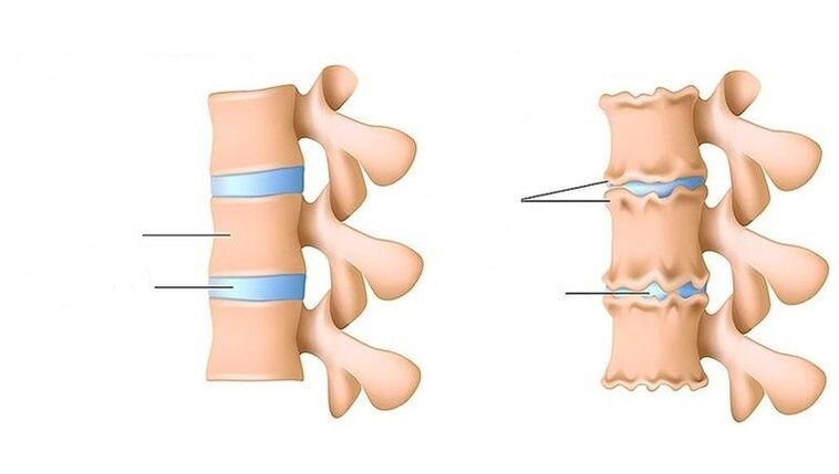 healthy spine and spine affected by osteoarthritis