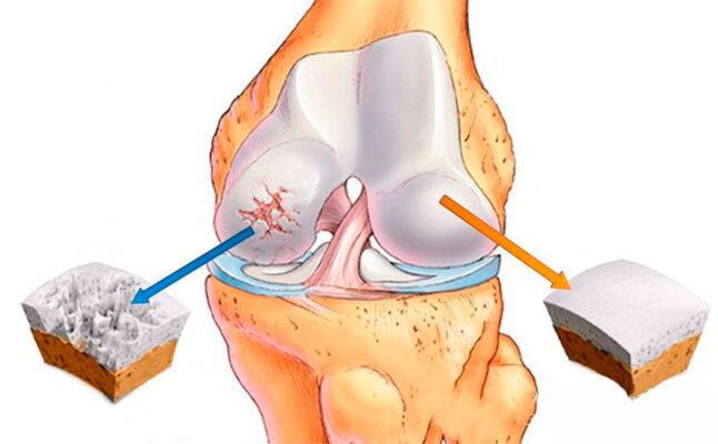 A normal knee joint (right) and a degenerative knee joint (left)