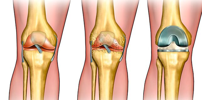 In the third stage of joint disease, knee replacement is required