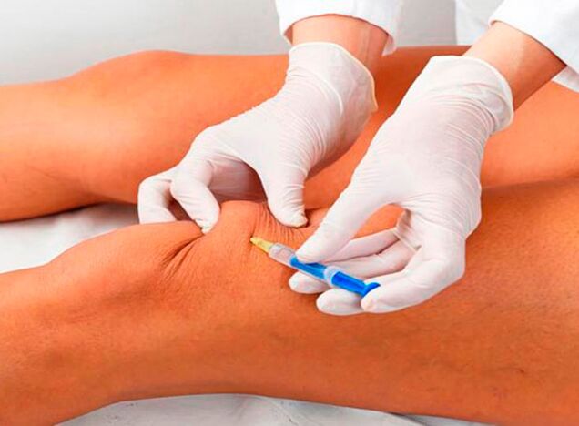 Intra-articular injections treat knee osteoarthritis