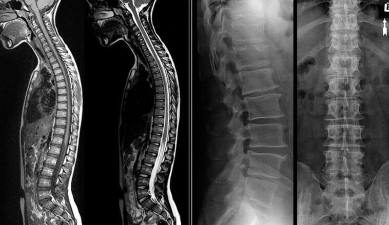 X-ray and MRI imaging for osteonecrosis