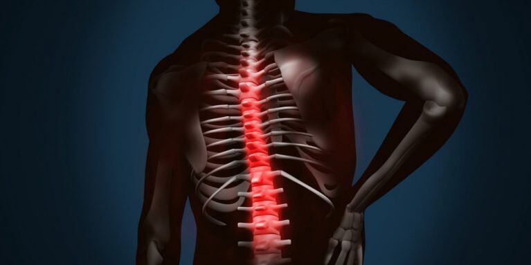 spinal cord injury with osteonecrosis