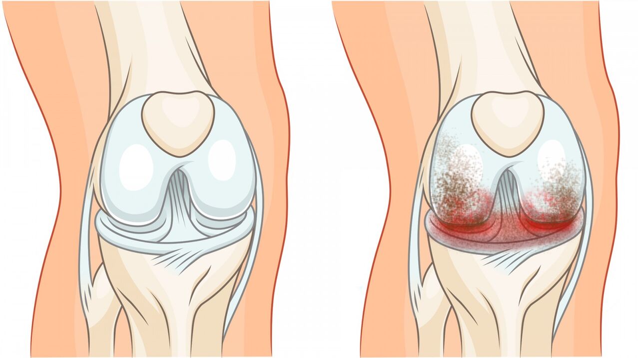 healthy joints and arthritis of the knee joint