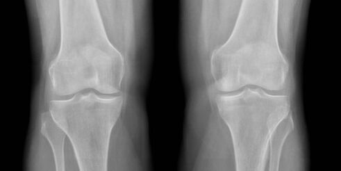 X-ray of knee osteoarthritis