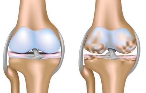 healthy joints and destruction of the knee joint in arthritis