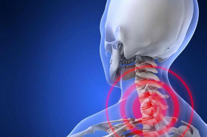 Neck pain - an early symptom of cervical osteochondrosis