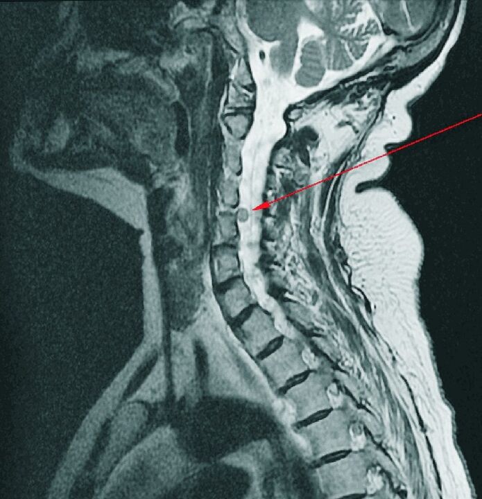 Cervical disc herniation on MRI