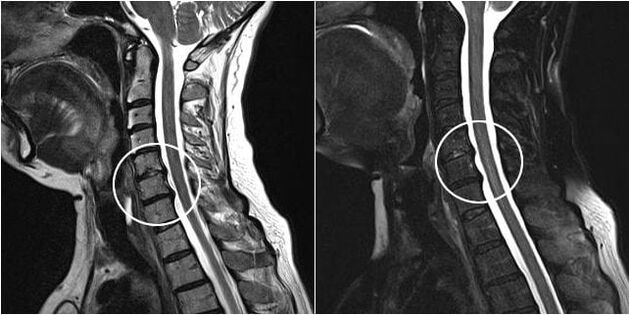 MRI scan of the cervical spine shows signs of bone necrosis