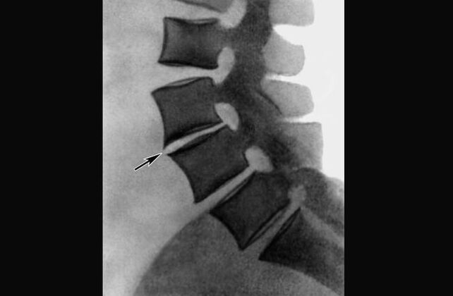 Manifestations of osteochondrosis of the thoracic spine on radiographs