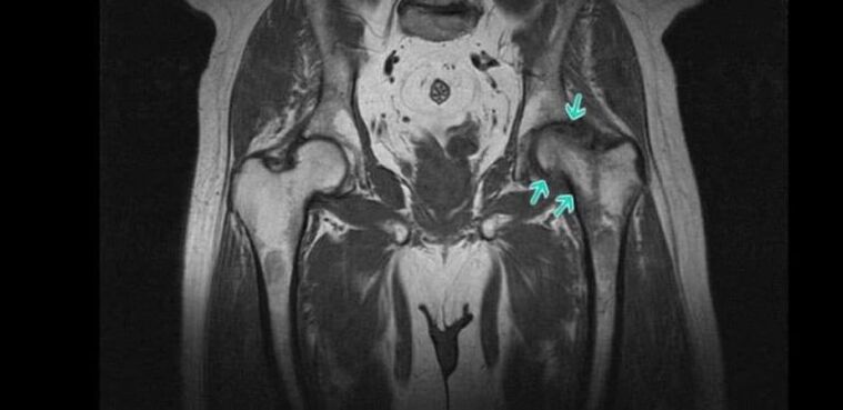 Degenerative-dystrophic changes in the hip on MRI