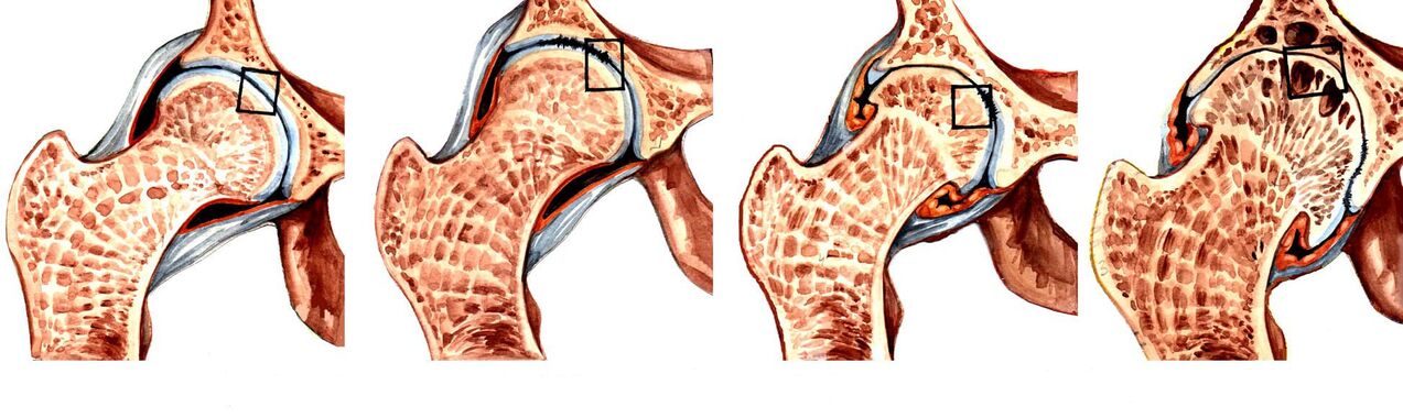 Degree of coxarthrosis