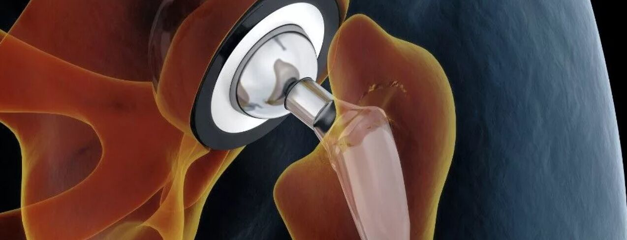 Medicine of the hip in terminal coxarthrosis