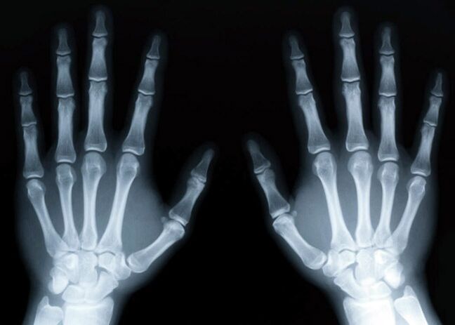 Gout stimulates the development of gouty arthritis, which can be diagnosed with X-rays