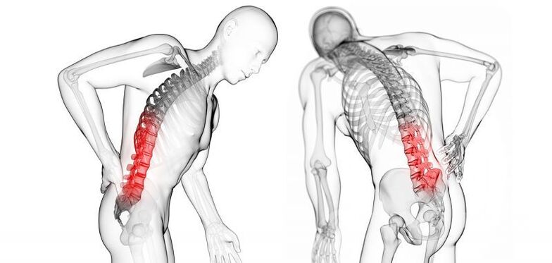 Complications of cervical spondylosis