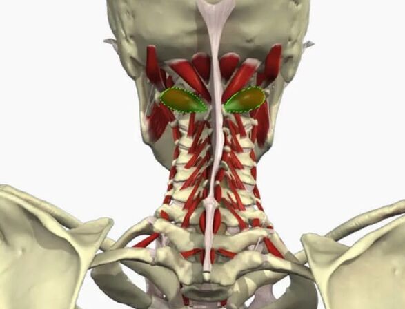 Valent artery syndrome